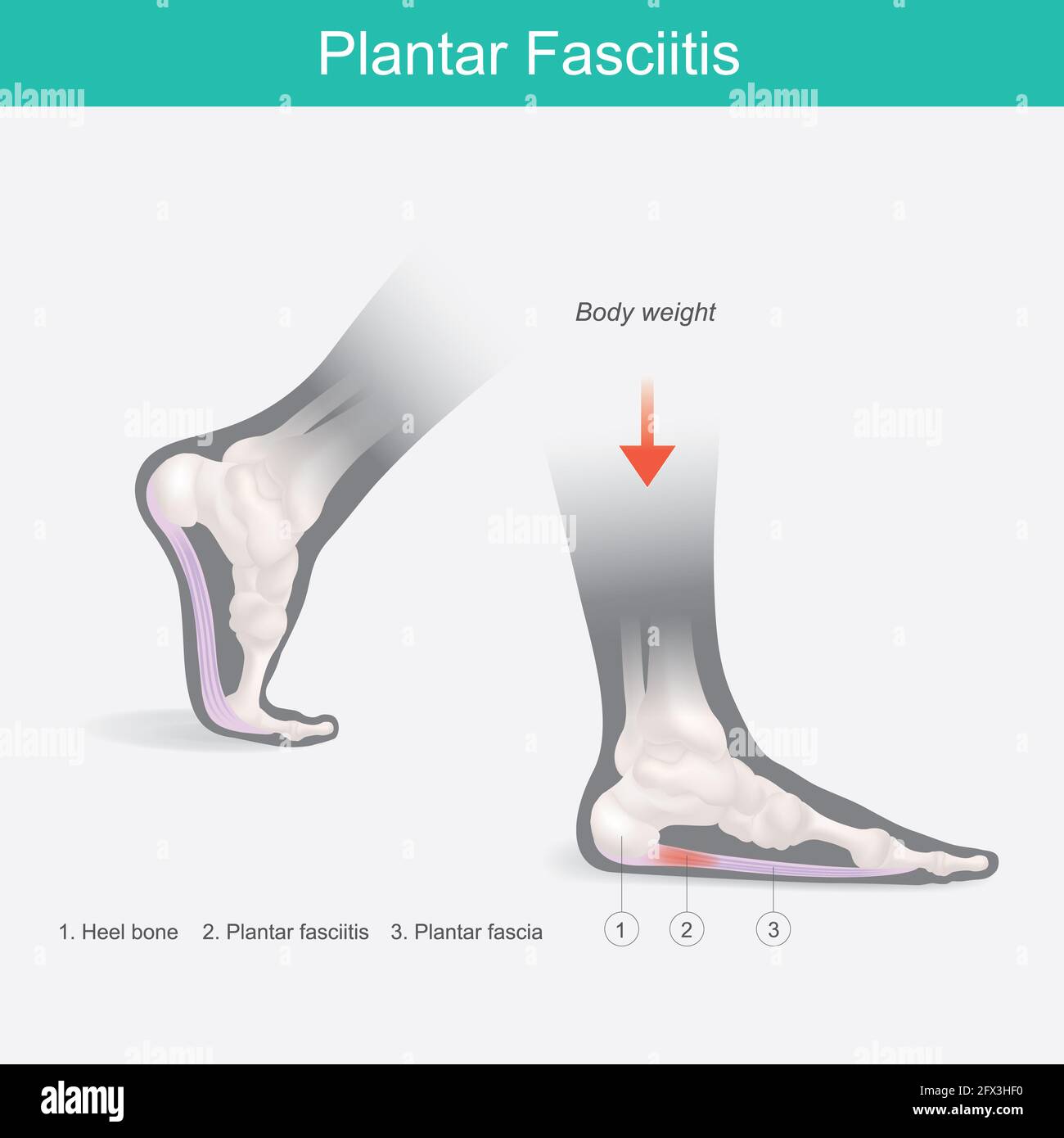 Plantar Fasciitis. Illustration human foot anatomy explain on symptom plantar fasciitis. Stock Photo