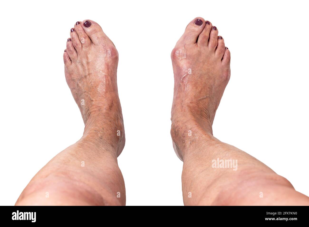 Hallux valgus, bunion on elderly woman's feet isolated on white background. Painful toe joint deformity with misalignment of toes. Close-up, top view. Stock Photo