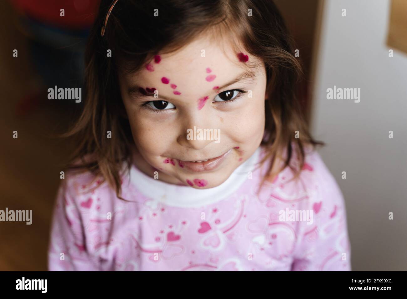 Toddler girl with chickenpox measles on the body. Varicella virus