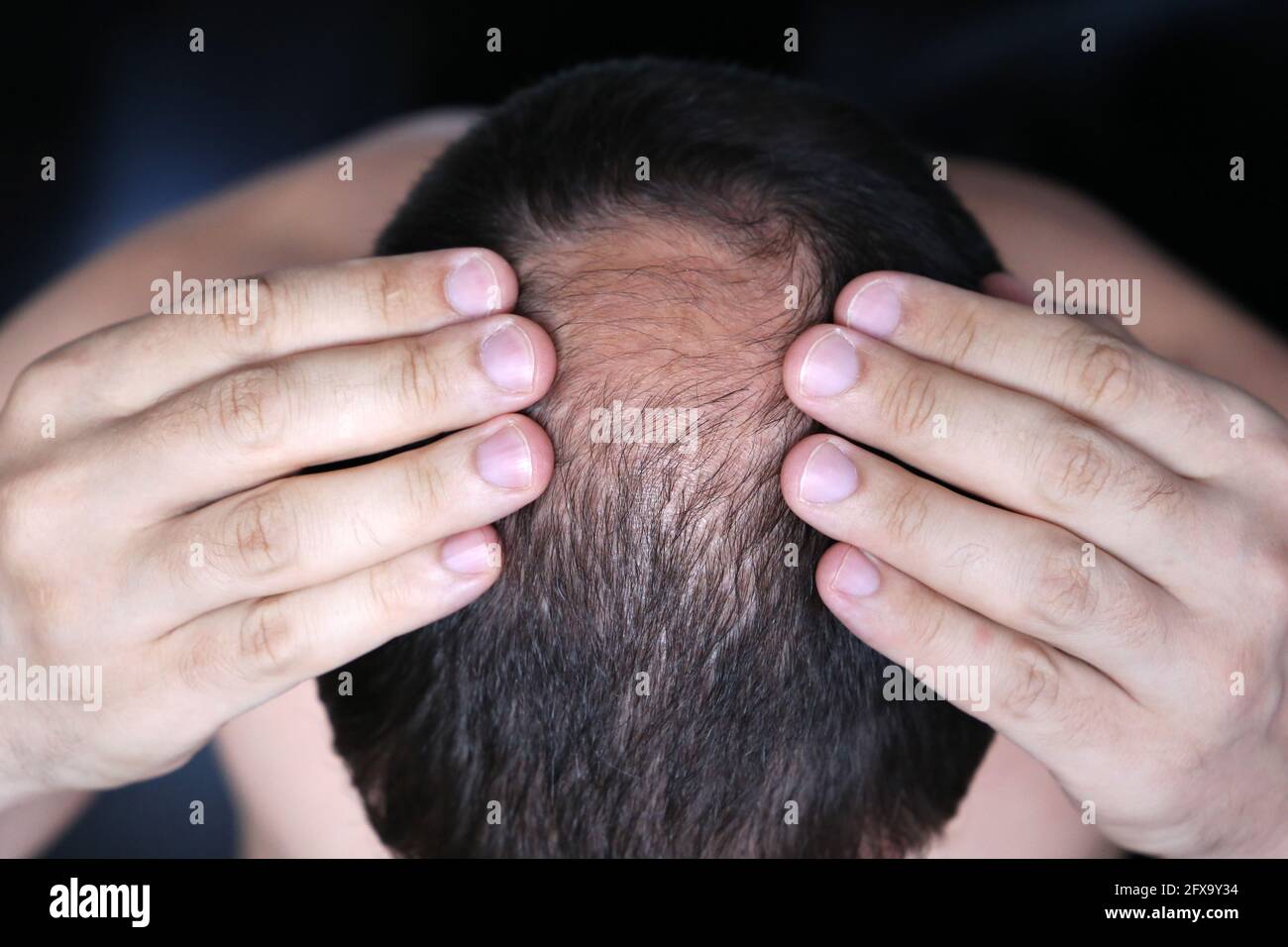 Baldness, man concerned about hair loss. Male head with a bald Stock Photo