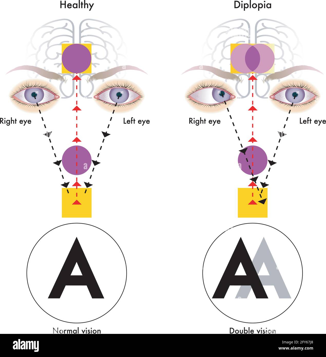 Medical illustration of the symptoms of diplopia. Stock Vector