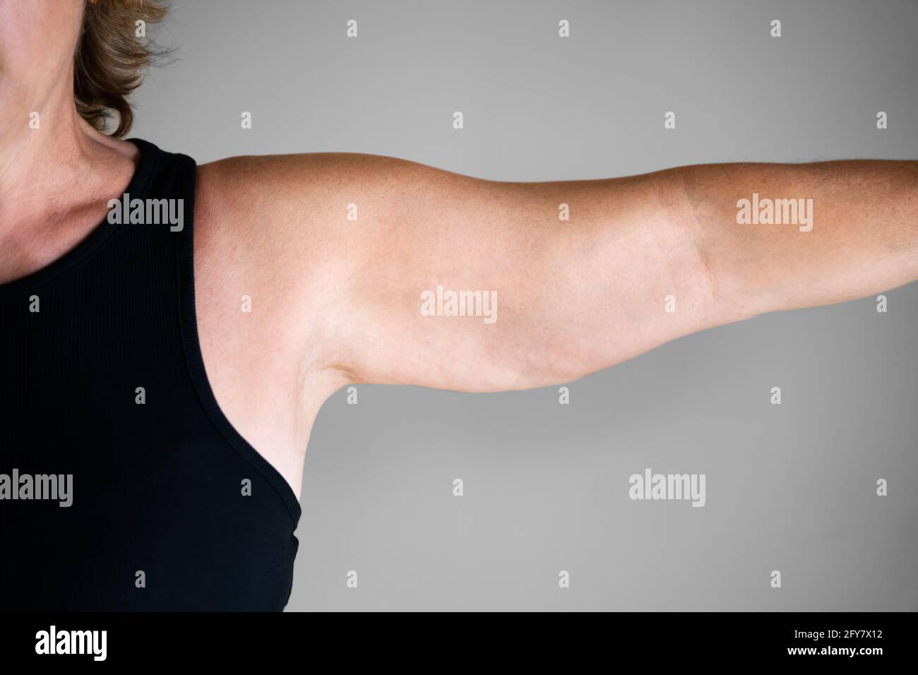 Overweight Lady Arm With Excess Fat. People Obesity Stock Photo Alamy