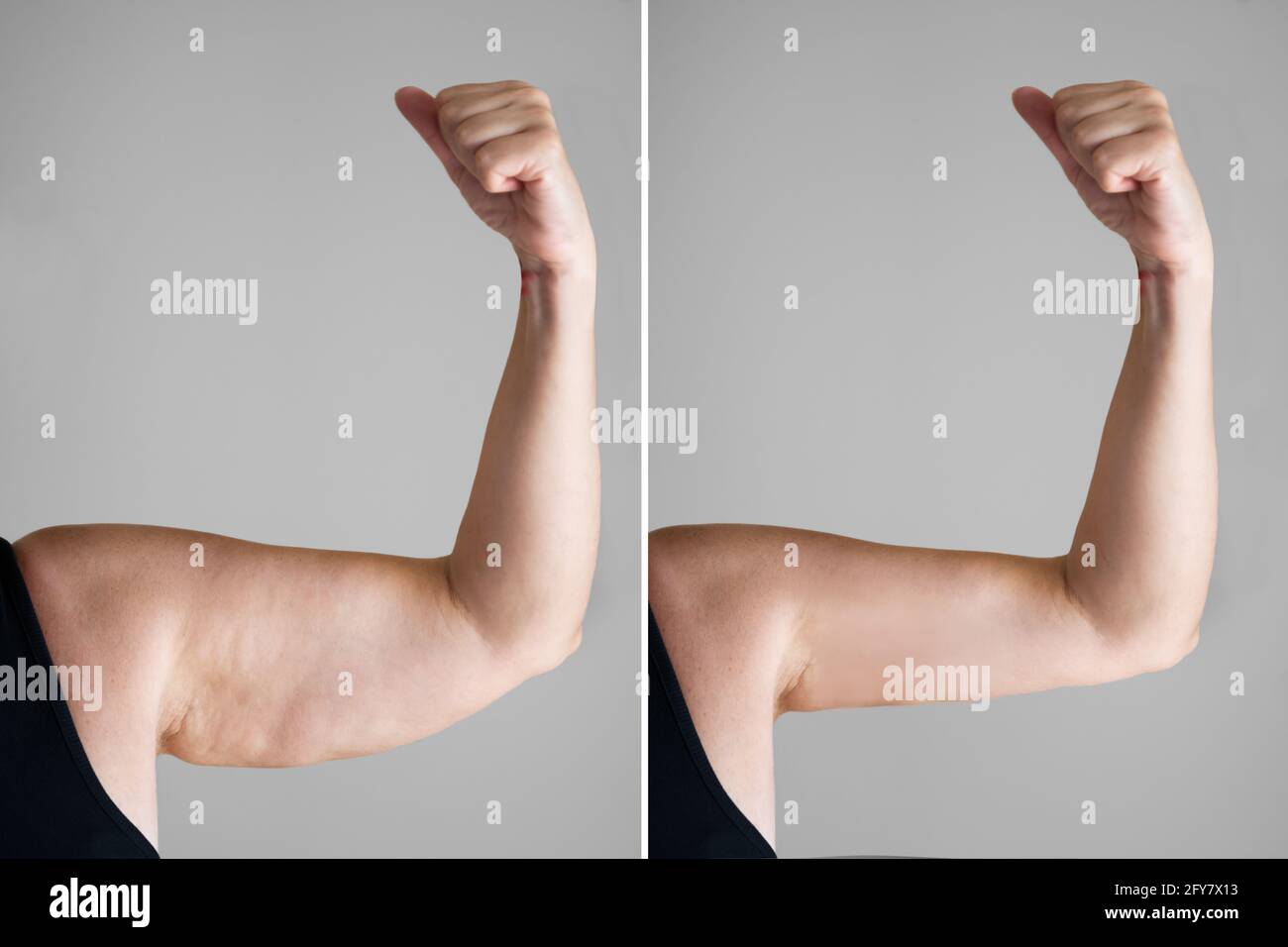 Obesity Cellulite And Fat Removal Surgery Before And After Stock