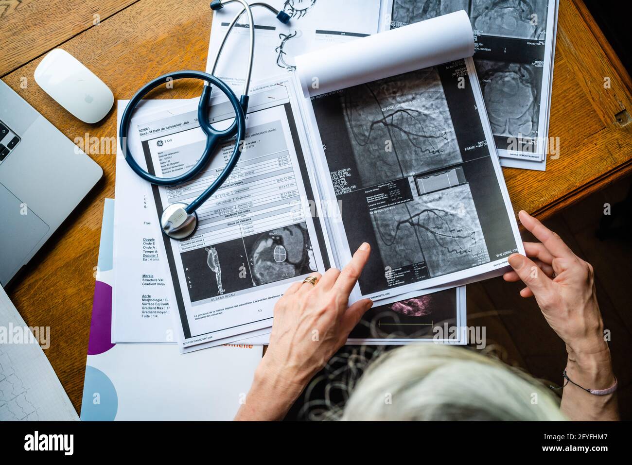 Coronary angiogram stenosed artery. Stock Photo