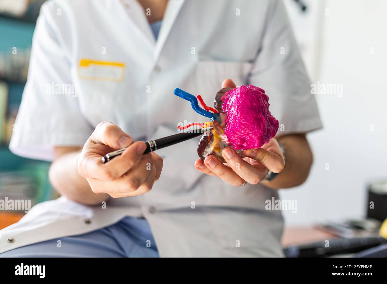 3D printed kidney model with tumor, 3D printing improves the preparation of the surgeon who thus visualizes the complexity of the case, It also allows Stock Photo