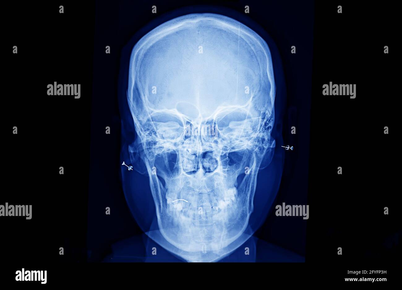 Film xray skull and cervical spine lateral view, XRay film of human
