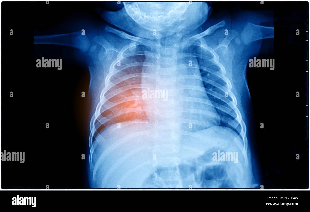 X-Ray Image Of Human Chest for a medical diagnosis, coronavirus or Covid-19 concept Stock Photo
