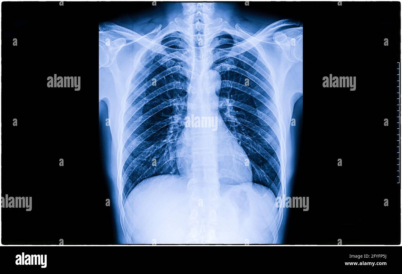 X-Ray Image Of Human Chest for a medical diagnosis, coronavirus or Covid-19 concept Stock Photo