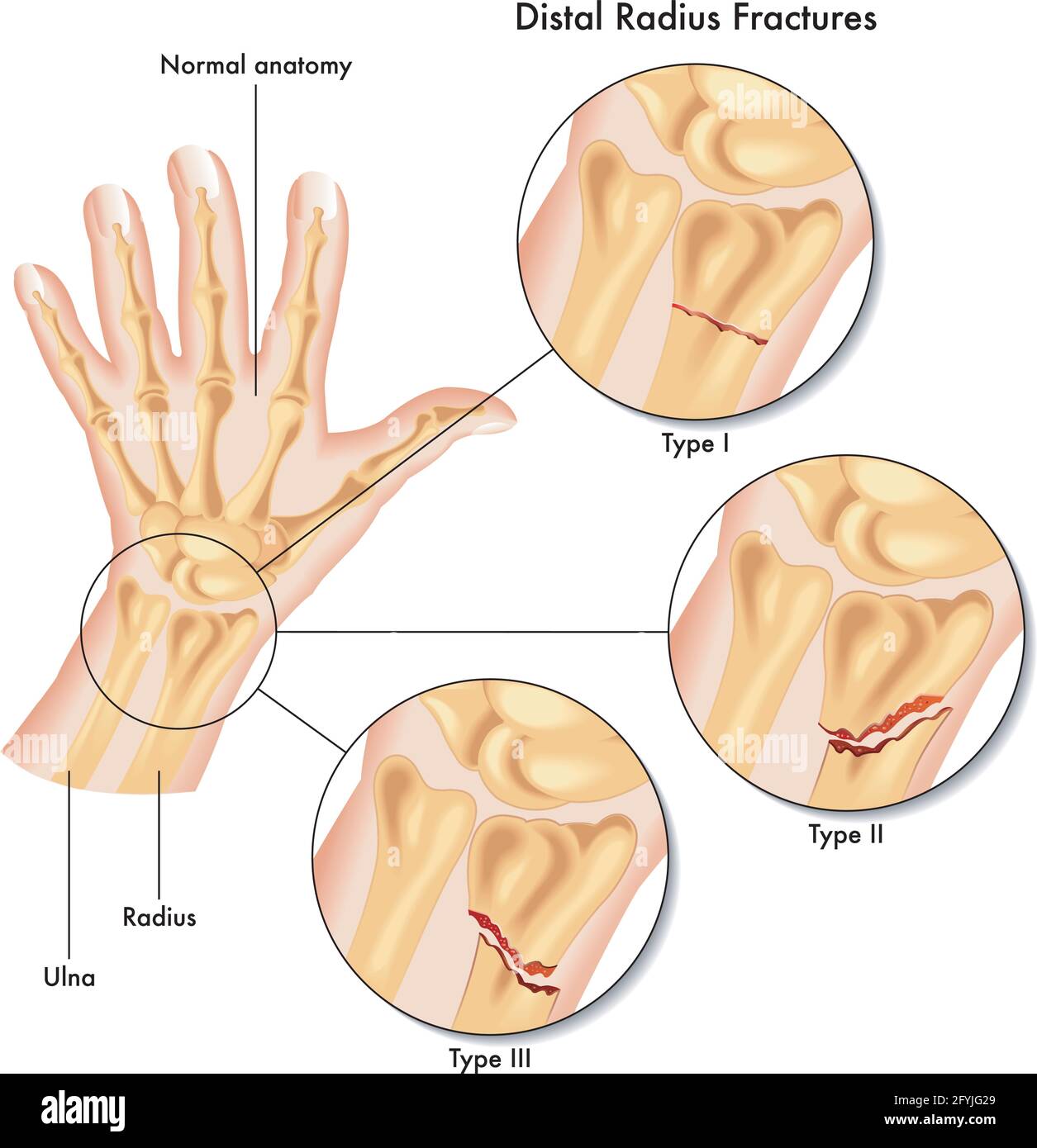 Medical illustration of the various kinds of fracture of the distal ...