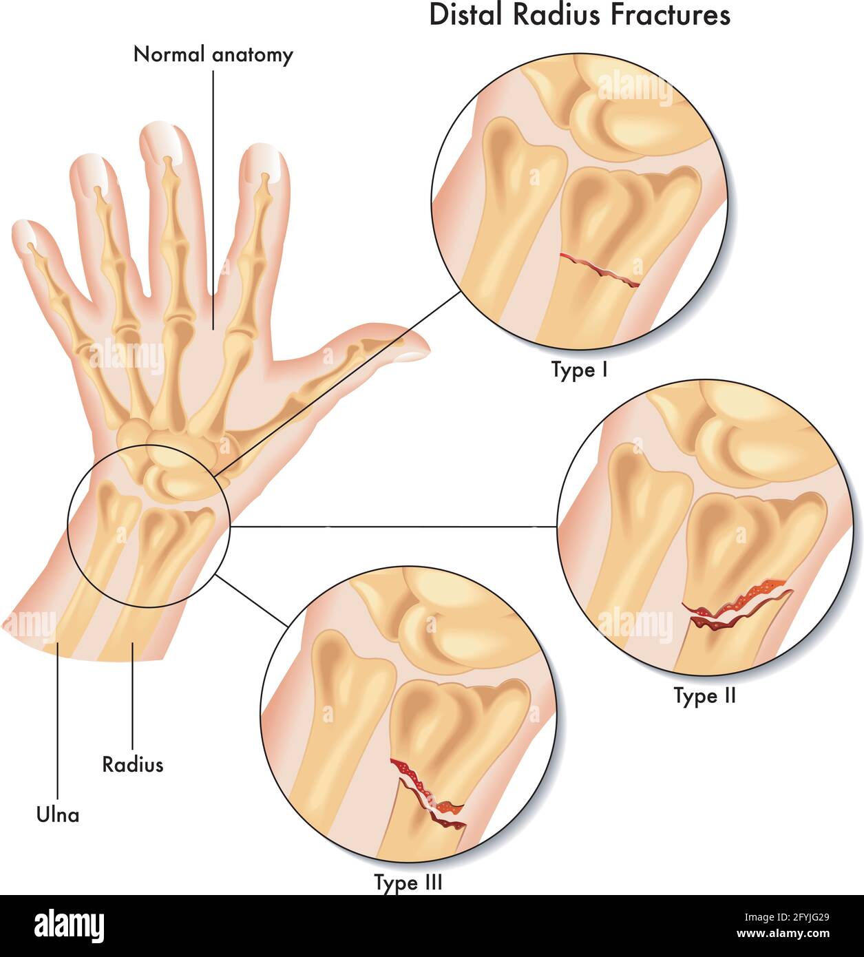 Medical illustration of the various kinds of fracture of the distal radius. Stock Vector