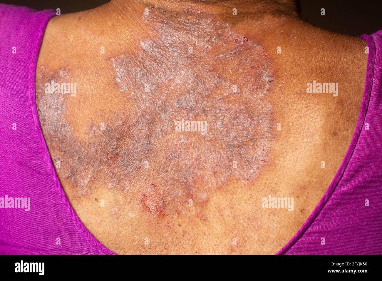 Psoriasis Skin Cream High Resolution Stock Photography And Images Alamy