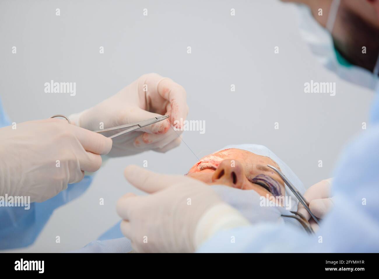 Blepharoplasty, plastic surgery operation for correcting defects