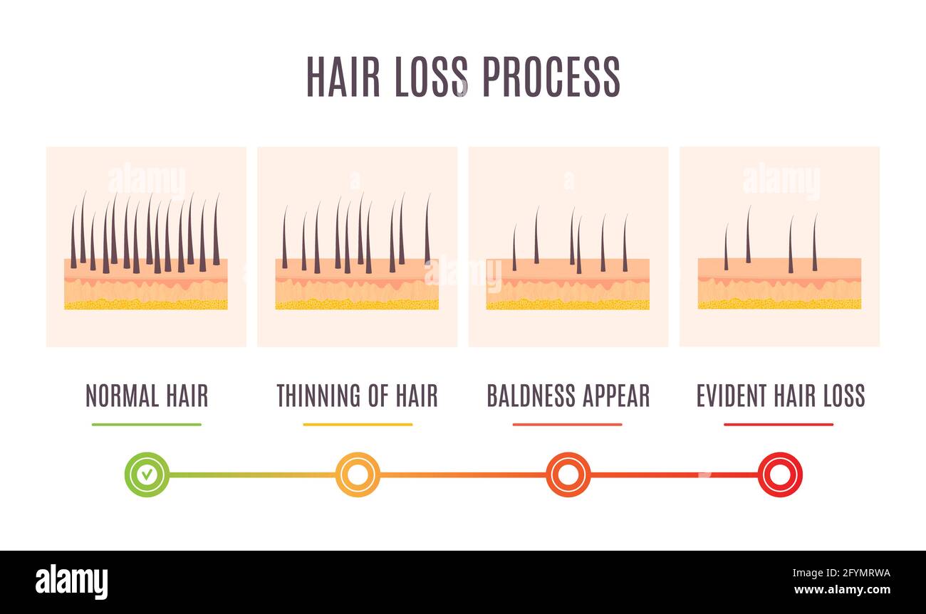 Hair loss stages, illustration Stock Photo