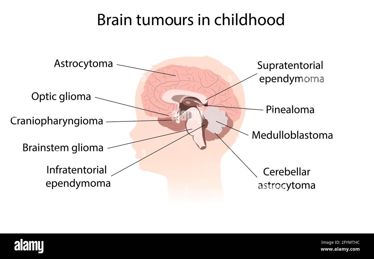Brain tumour  childhood, illustration Stock Photo