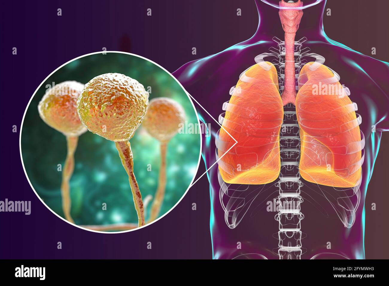 Pulmonary mucormycosis, illustration Stock Photo