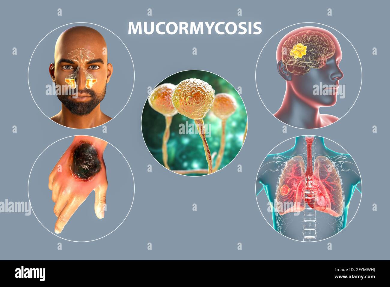 Clinical forms of mucormycosis, illustration Stock Photo