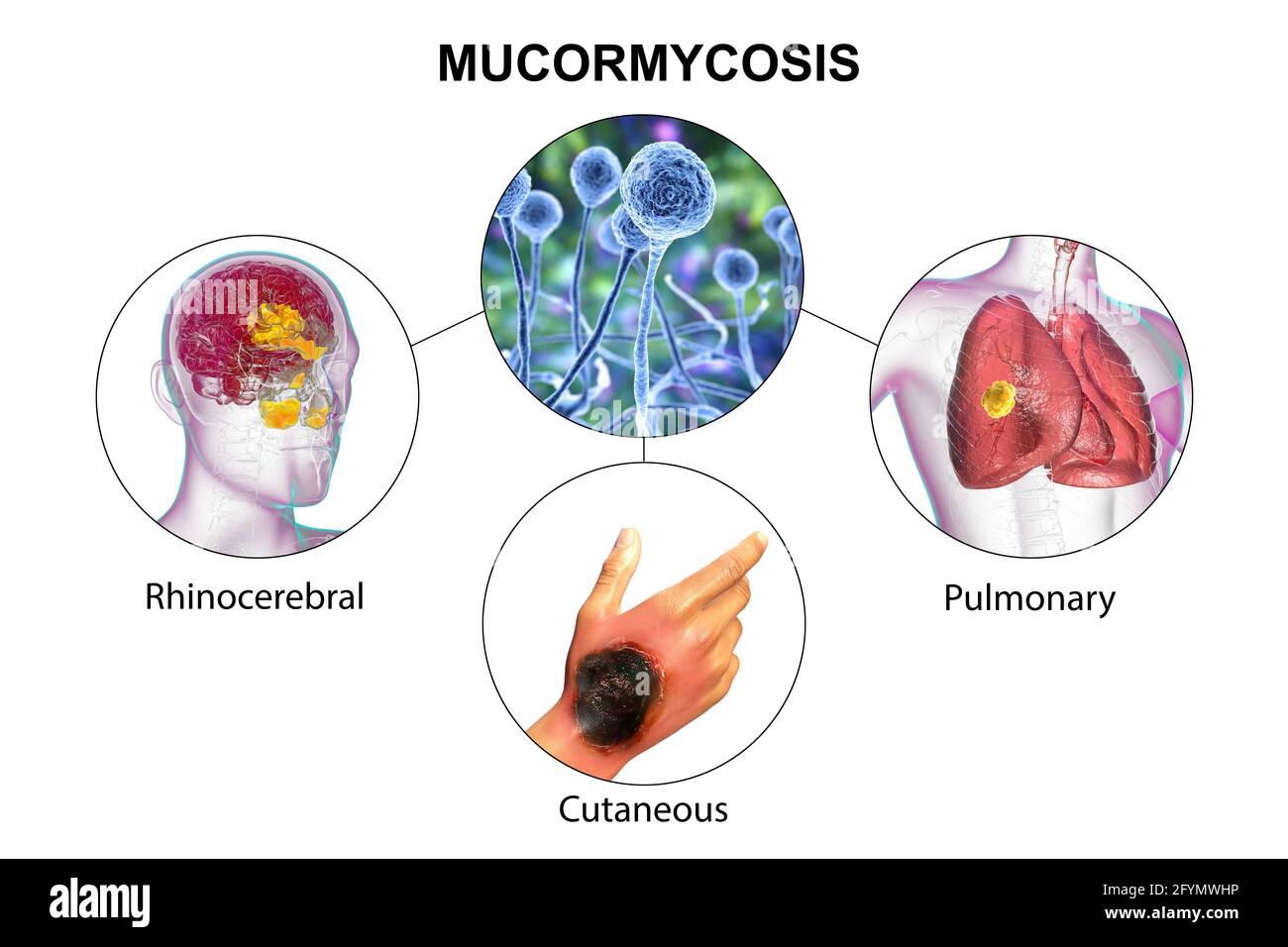 Clinical forms of mucormycosis, illustration Stock Photo