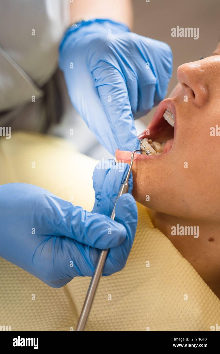 Teeth straightening braces stomatology procedure. Dentist removes