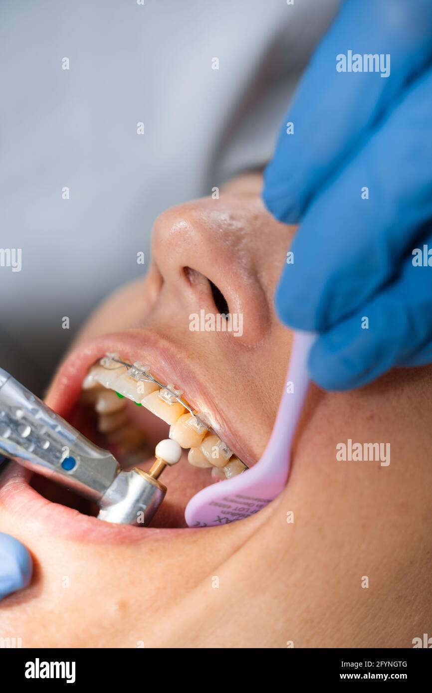 Dentist drill and polish tooth. Stomatology procedure for treatment