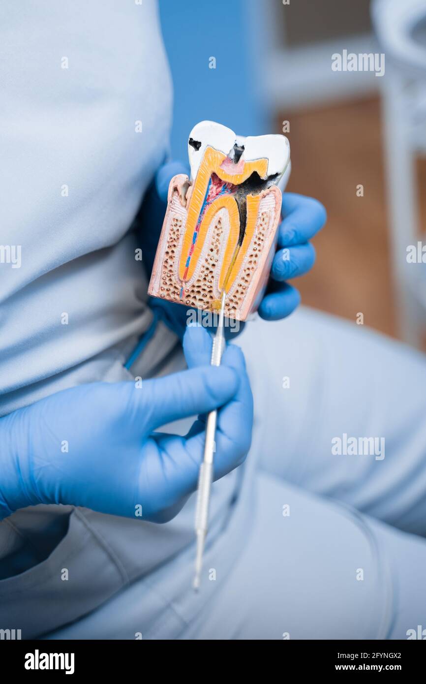 Dummy of a sick tooth with caries, Dentist shows structure of the teeth