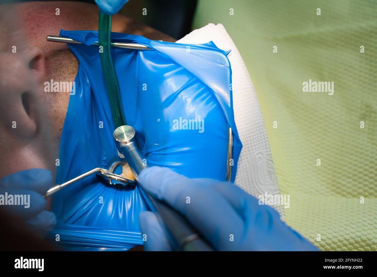 Dental treatment cofferdam in stomatology. Dentist using dental dam for