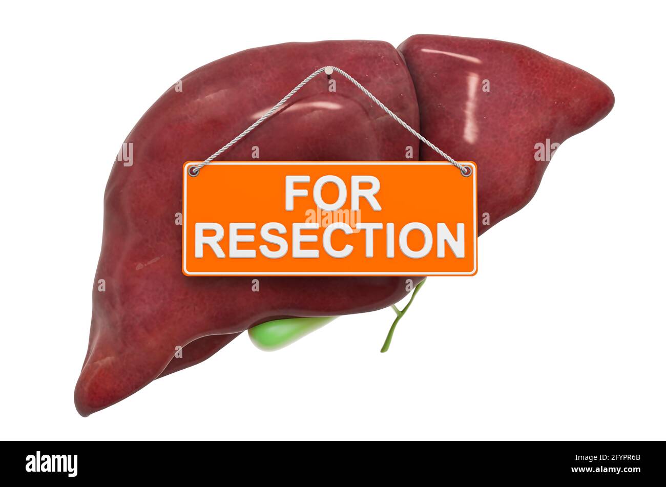 Liver resection hires stock photography and images Alamy