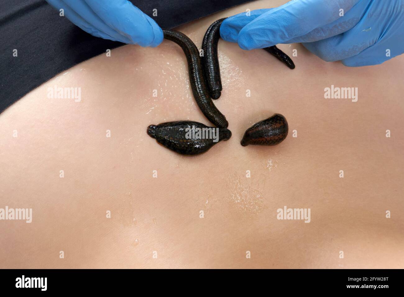 medical leeches on a human body drink blood. Treatment with leeches Stock  Photo - Alamy