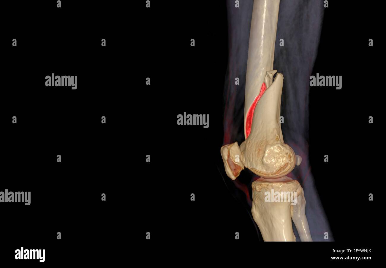 CT knee 3D rendering image Lateral view isolated on black background ...