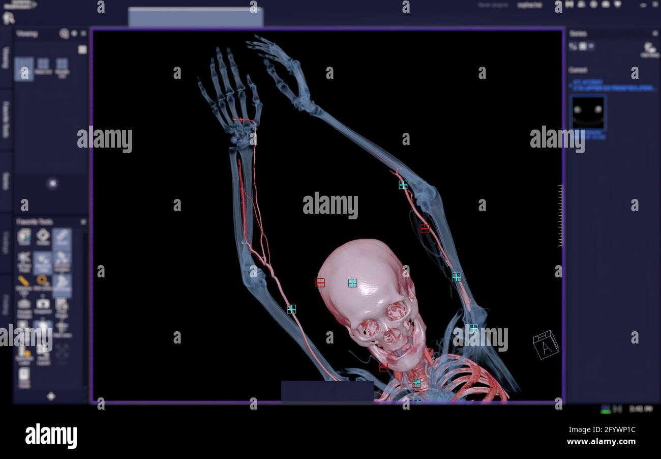 CTA brachial artery or CT scan of upper extremity or the Arm 3d