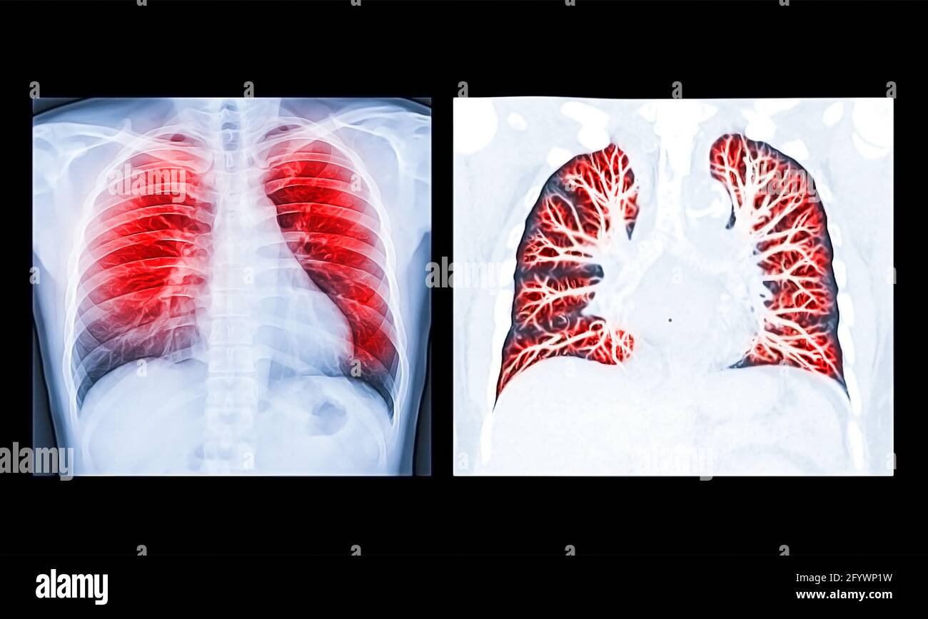 Oil paint effect Compare of Chest Xray or XRay Image and CT Chest