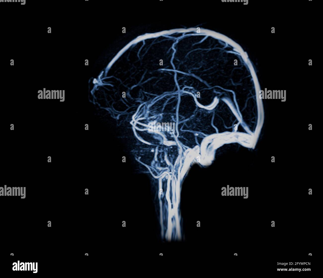 Collection 30+ Pictures what is an mrv of the brain Completed Collection 30+ Pictures what is an mrv of the brain Completed