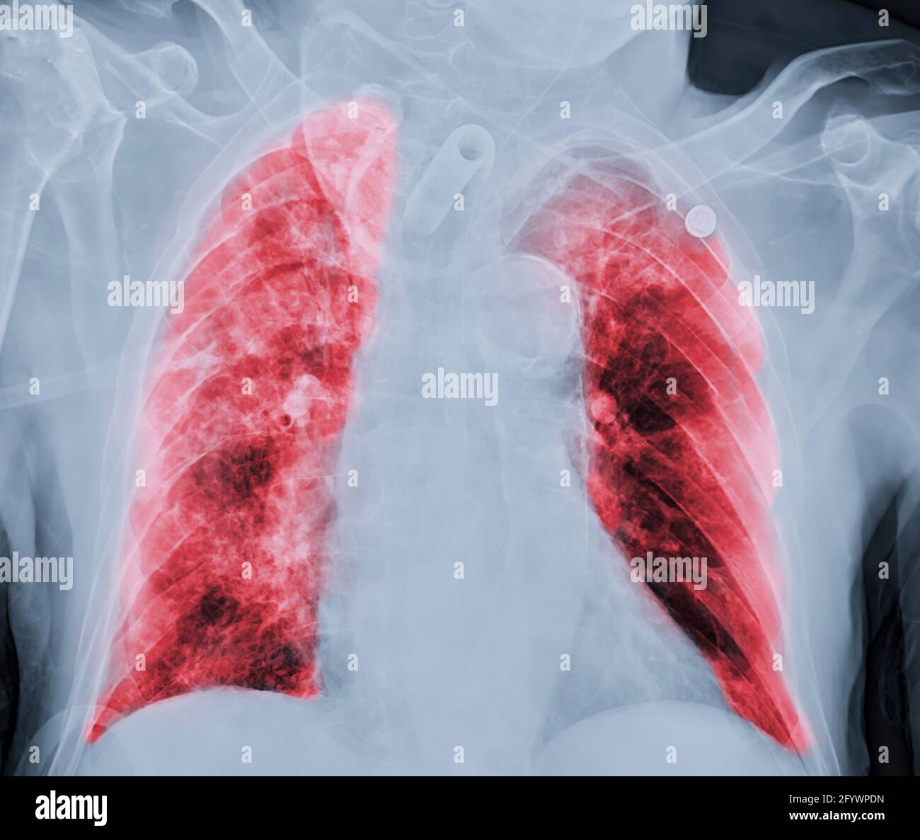 Chest Xray or XRay Image Of Human Chest or Lung ( red zone ) showing