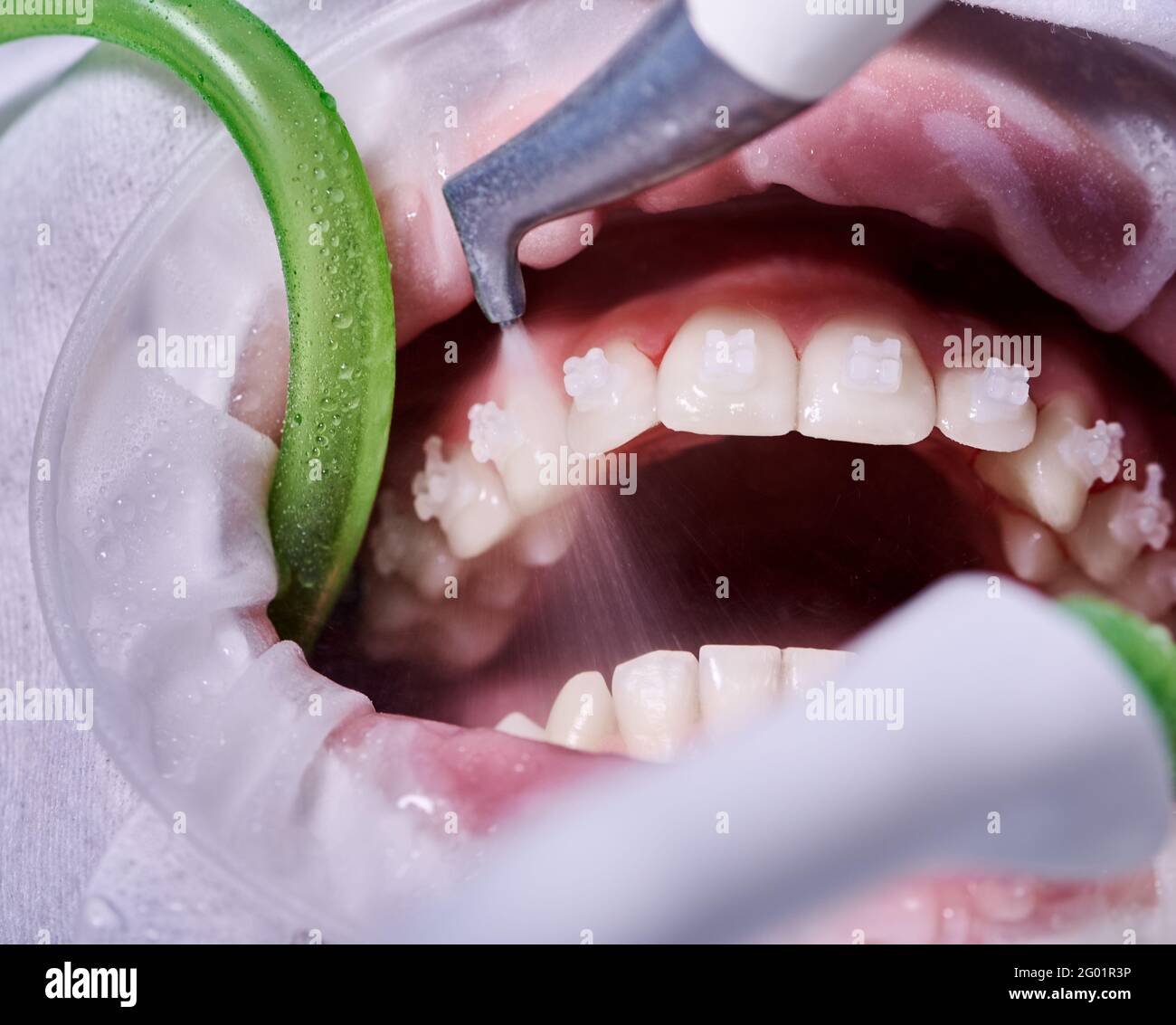 Macro photography. Top view on cleaning process in patient's mouth. Cleaning teeth with water jet and saliva ejector. Cheek retractor on the mouth. Concept of professional dental hygiene Stock Photo