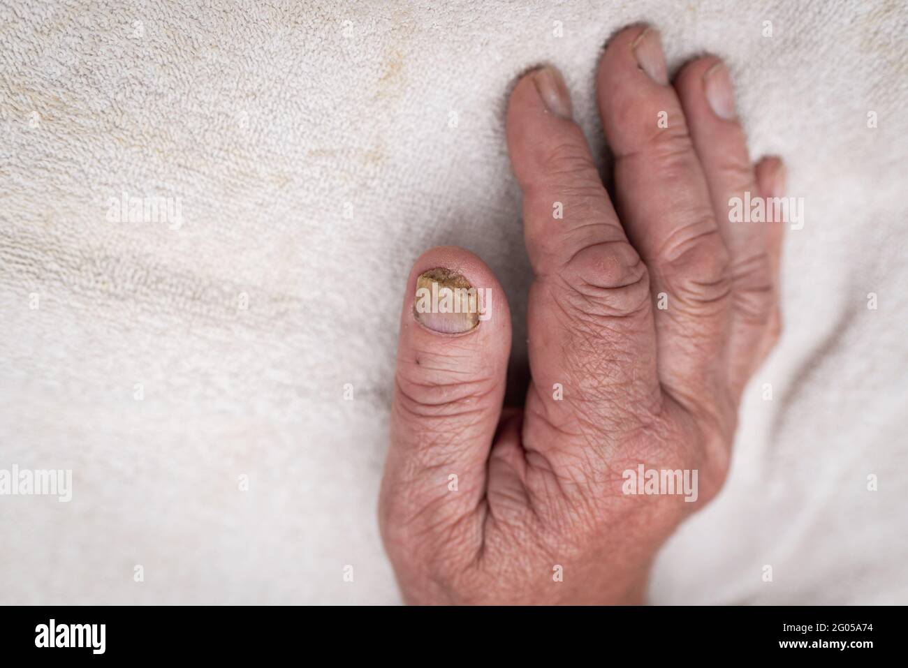 Premium Photo | Male cut nails with nail fungus fungal infection on nails  legs finger with onychomycosis care and treatment closeup of a foot with  damaged nails because of fungus
