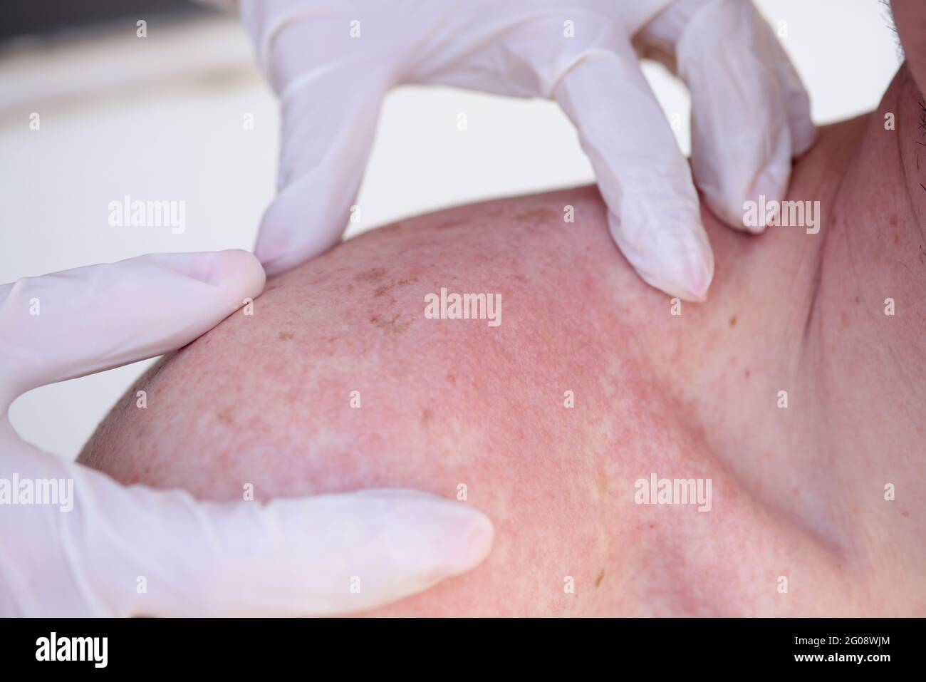 Gloved doctor conducts initial examination of a man sunburn Stock Photo
