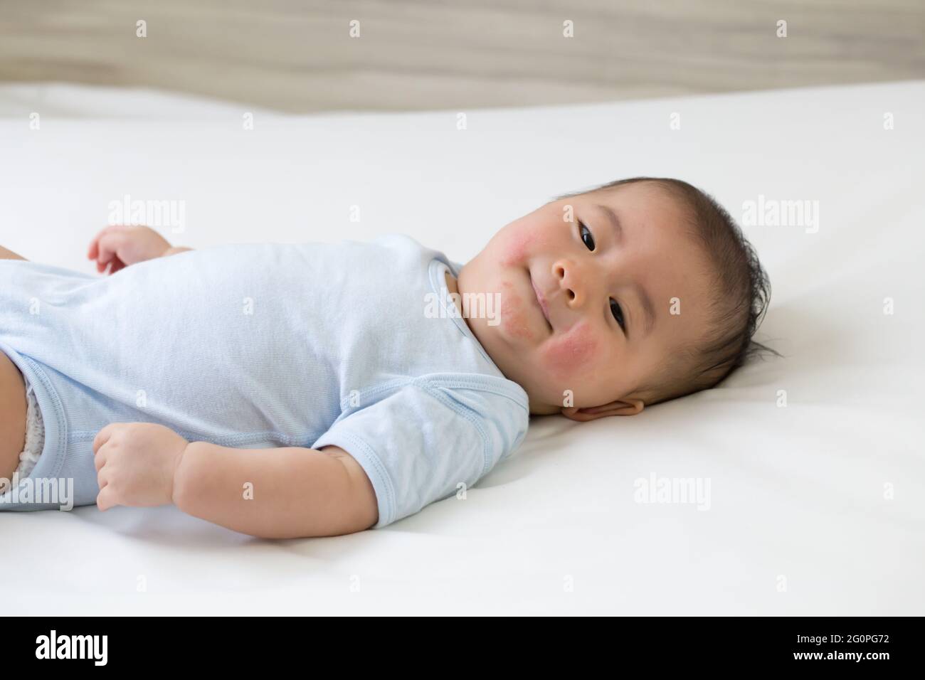 Asian baby boy lying on the bed and had a red rash on the face, Skin common rashes in newborn concept Stock Photo