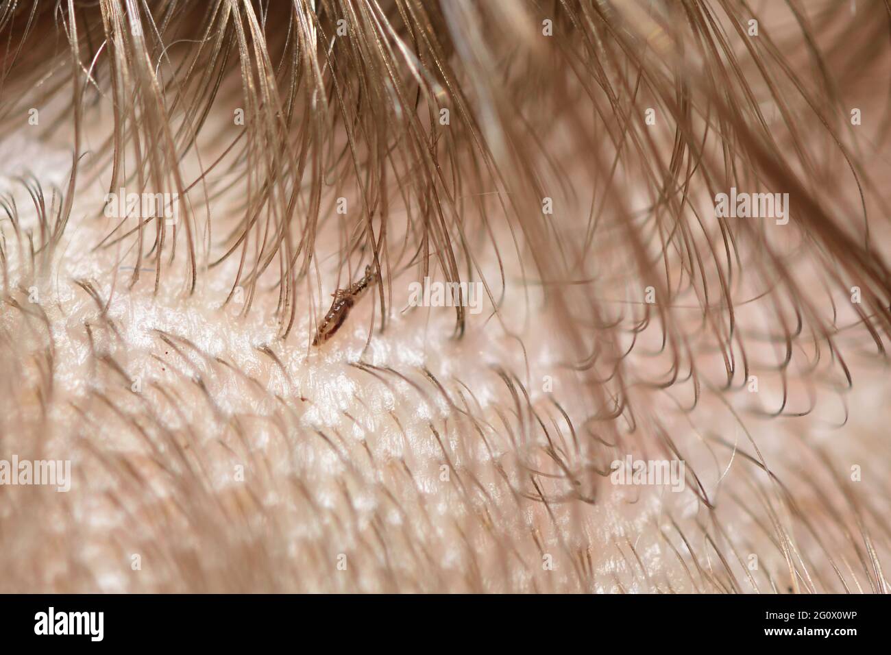 Dead lice in a child's hair after disinfection Stock Photo