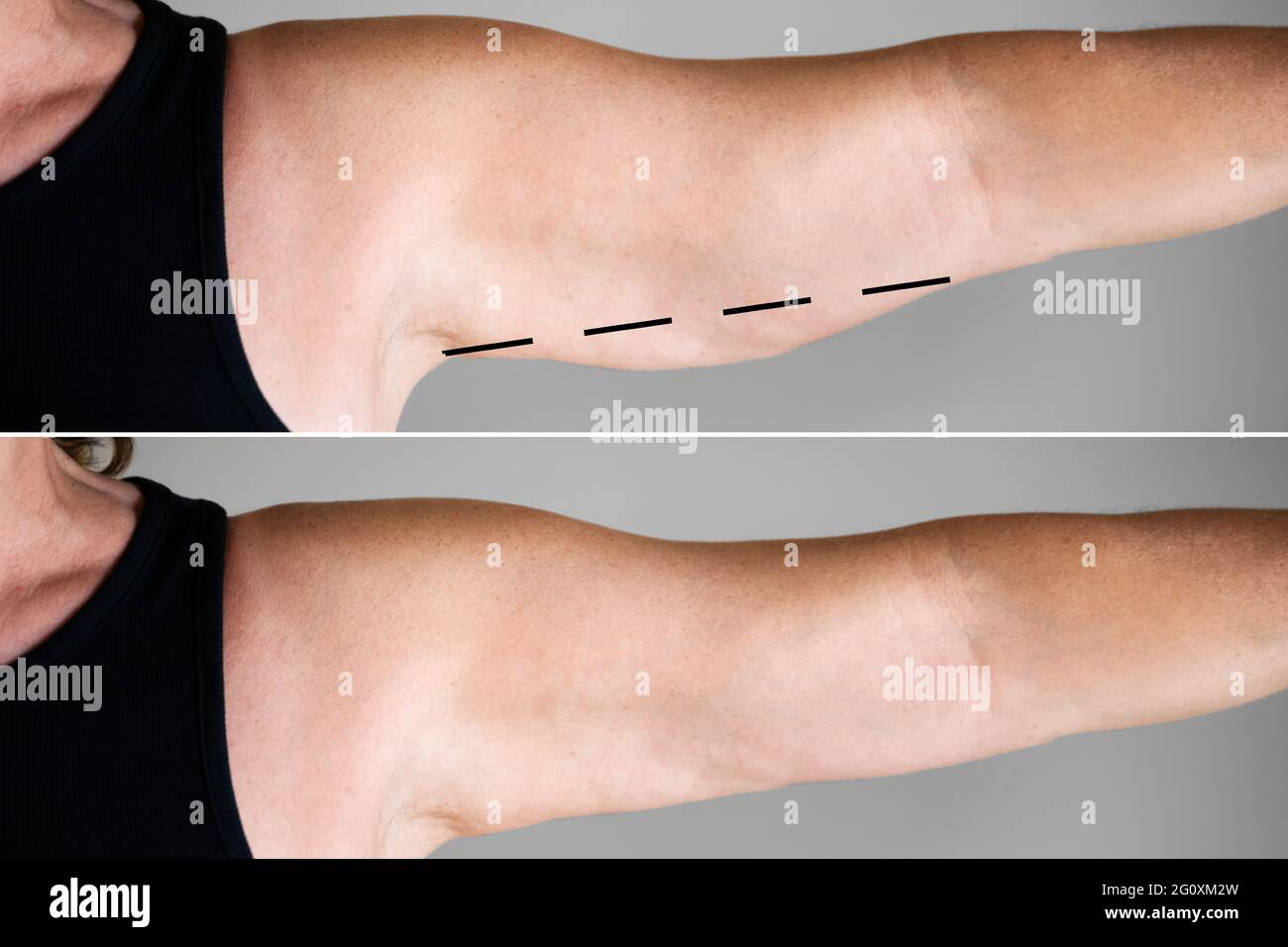 Obesity Cellulite And Fat Removal Surgery Before And After Stock Photo