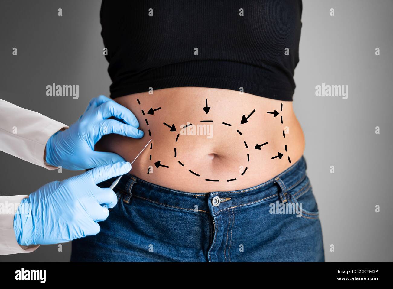 Abdominoplasty Obesity Surgery. Aesthetic Abdominal Fat Liposuction