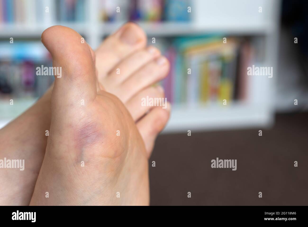 Bruise bruised hires stock photography and images Alamy