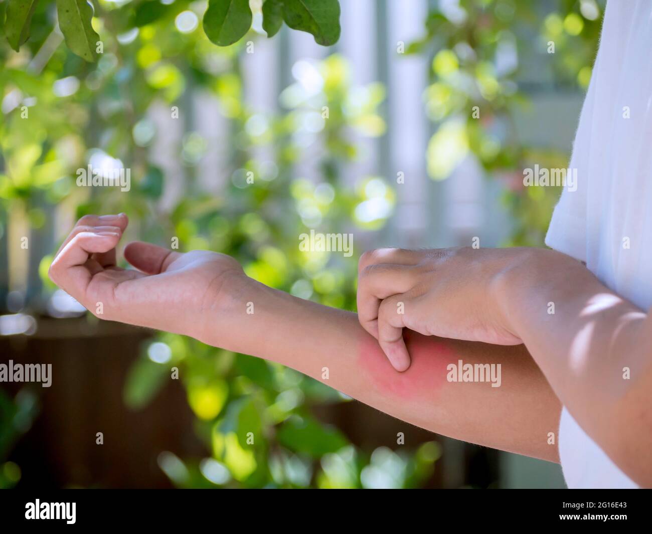 Young boy scratching the itch on his arm skin red rash. The allergy itch skin from mosquito bite, skin include dermatitis (eczema), food or drugs alle Stock Photo