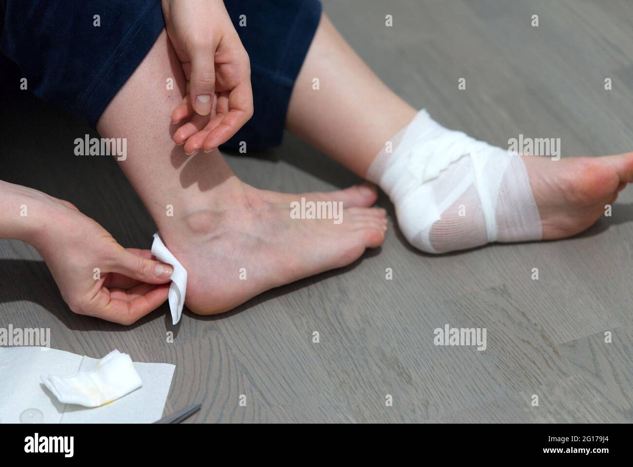 callus on leg. Girl uses ointment, Band-Aid and bandage to treat calluse Stock Photo