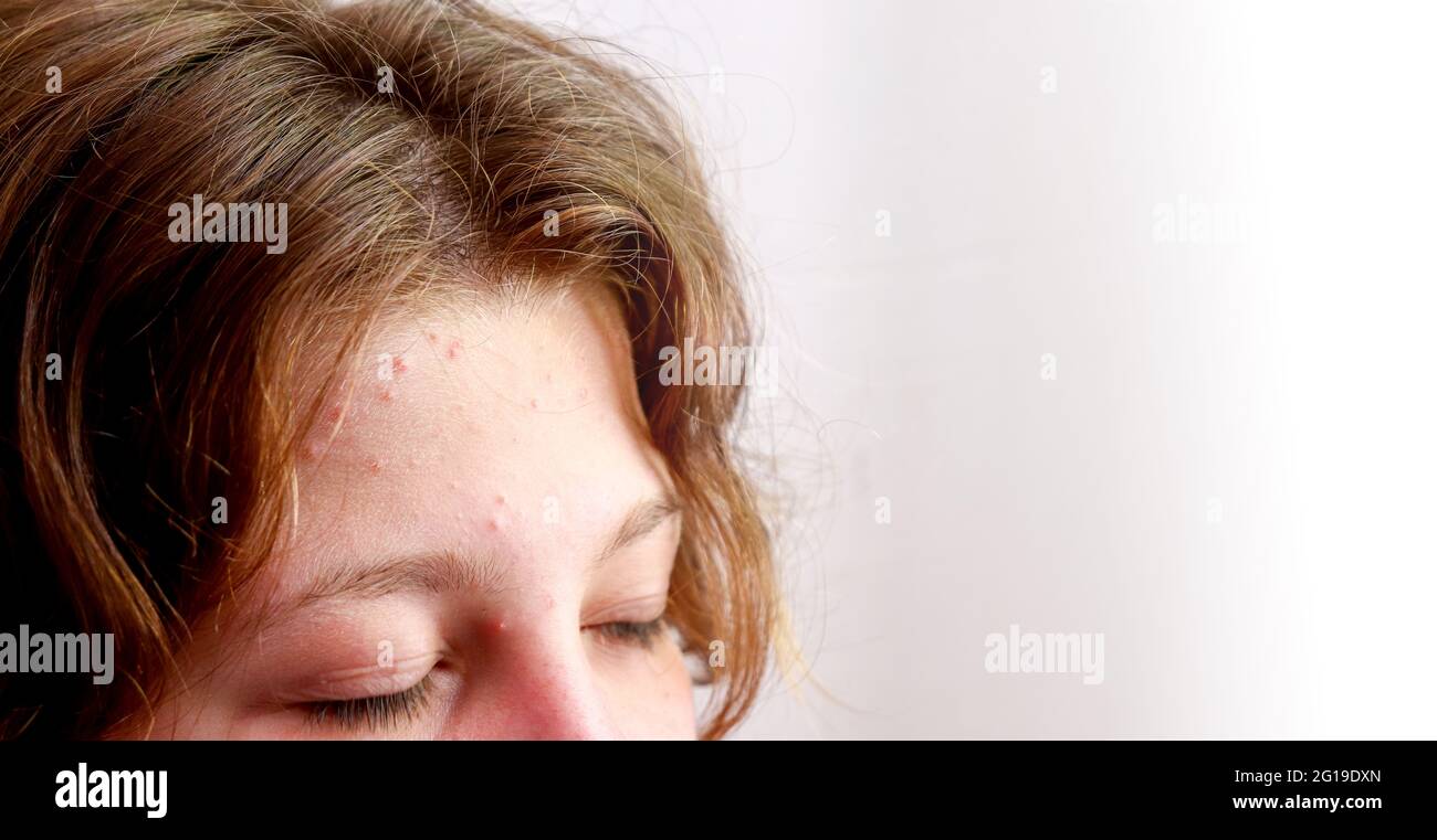White spot on forehead hi-res stock photography and images - Alamy