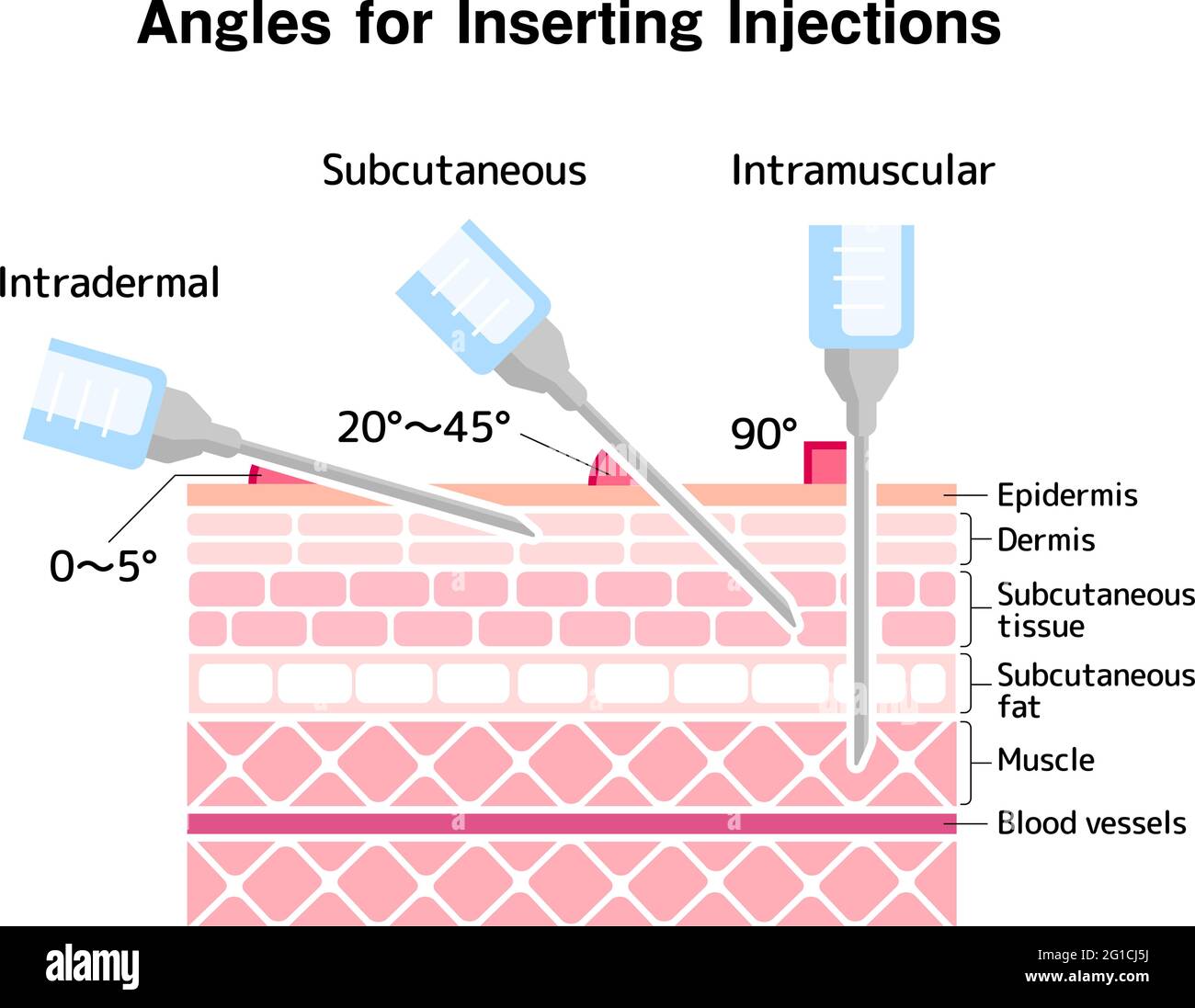 Angles for Inserting Injections vector illustration Stock Vector
