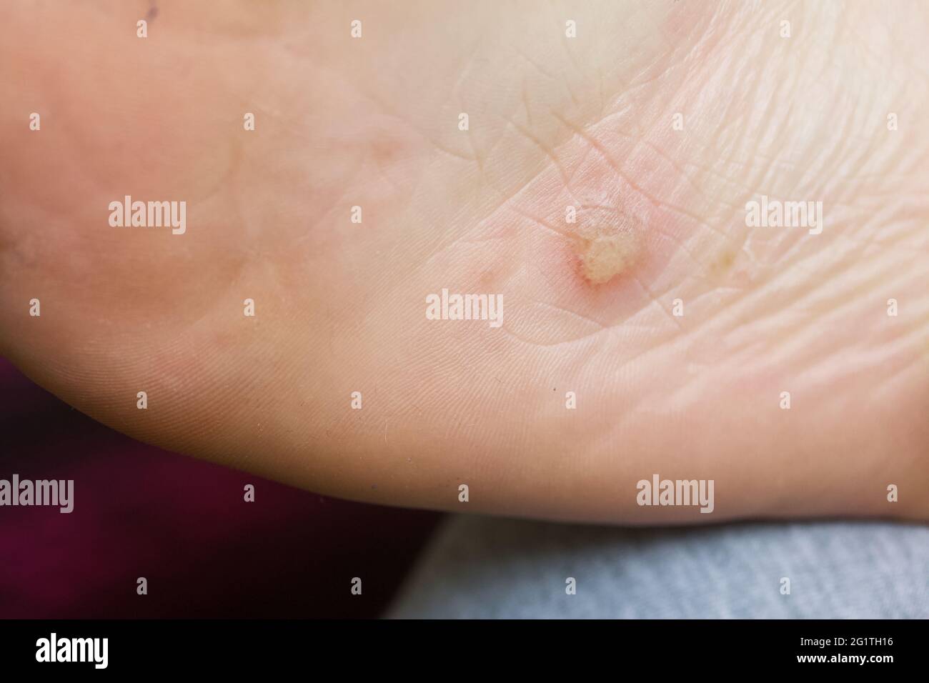 Dyshidrotic eczema on the foot. Blister dermatitis. Closeup shot Stock Photo Alamy