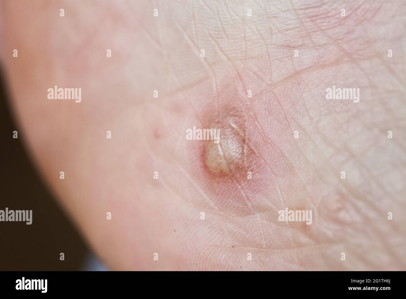 Dyshidrotic eczema on the foot. Blister dermatitis. Closeup shot Stock