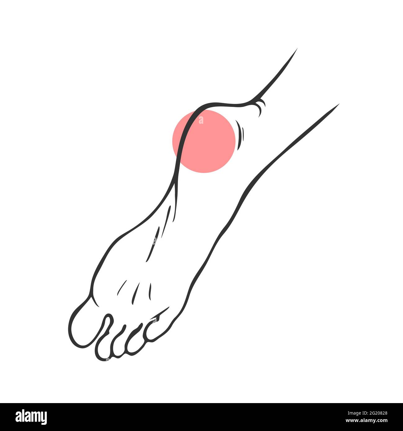 Leg with heel pain. Orthopedic disease plantar fasciitis. Vector isolated outline illustration Stock Vector