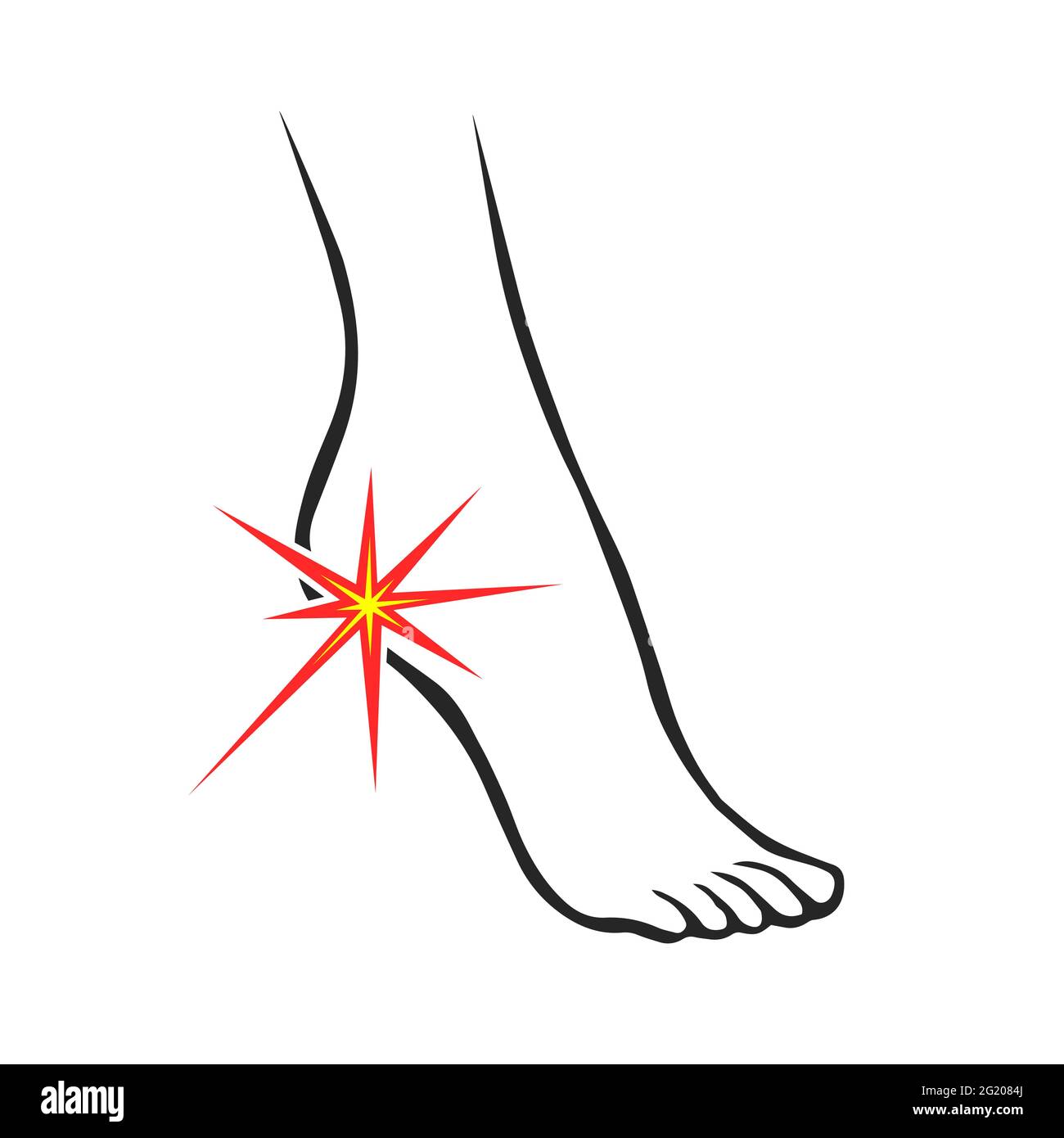 Leg with heel pain. Orthopedic disease plantar fasciitis. Vector isolated outline illustration Stock Vector