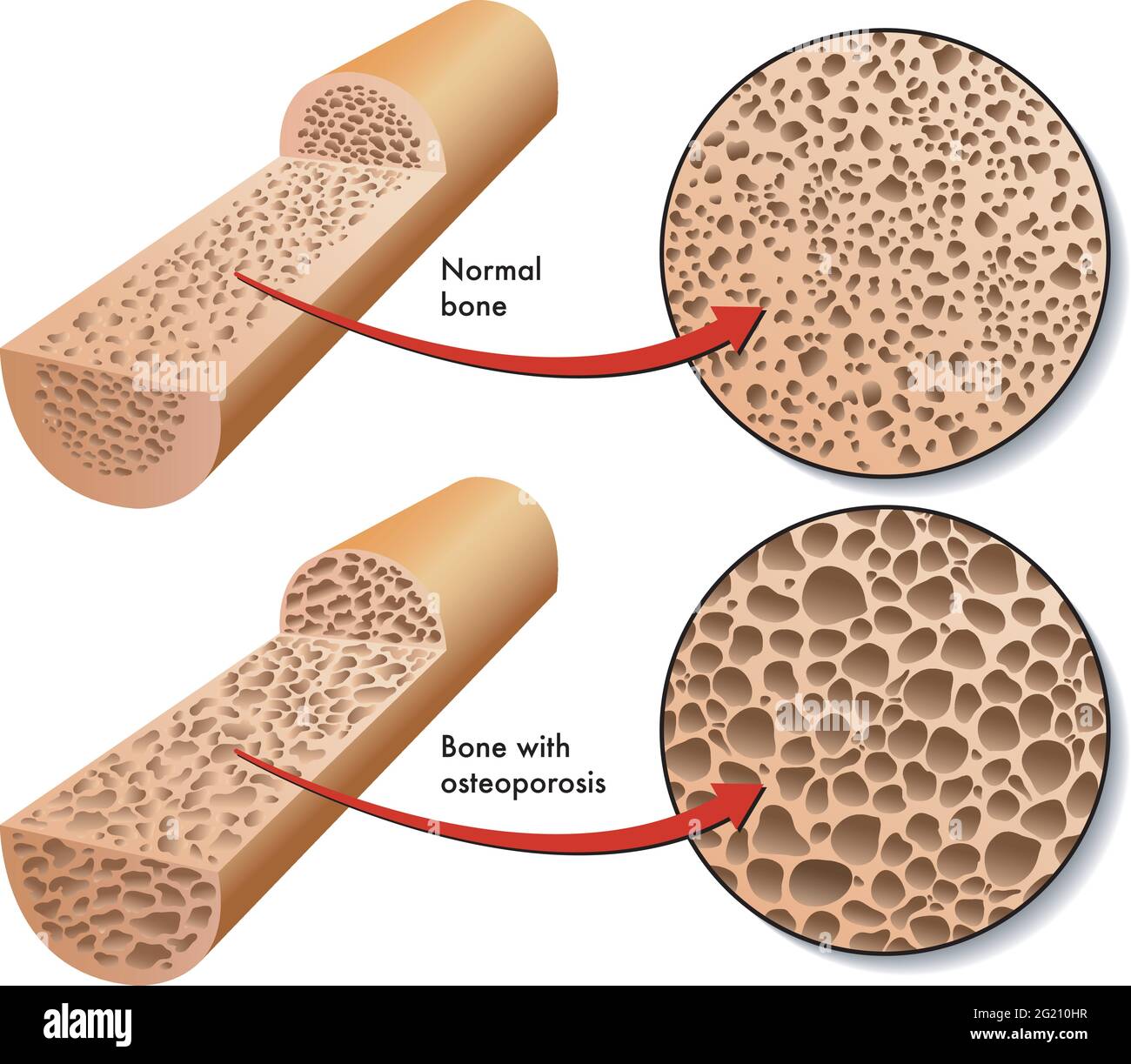 Medical illustration compares the section of a normal bone with the section of a bone affected by osteoporosis. Stock Vector
