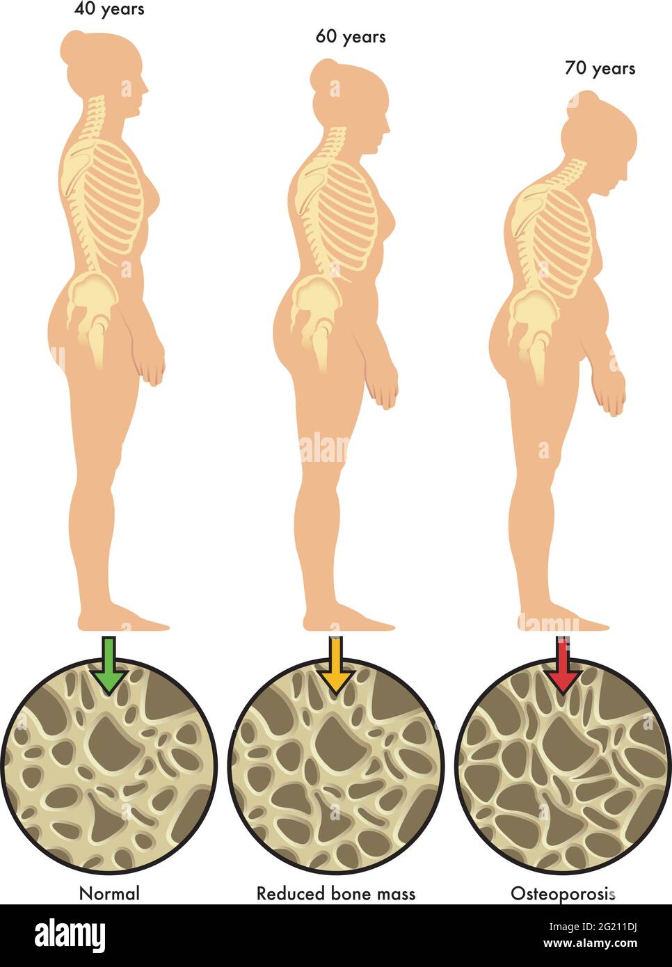 Medical illustration of the effects of osteoporosis in the course of a woman's life. Stock Vector